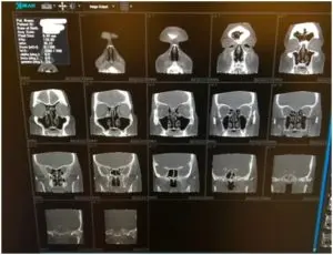sinus cavities 1 300x230