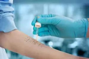 undergoing procedure of allergen skin tests in clinic 300x200