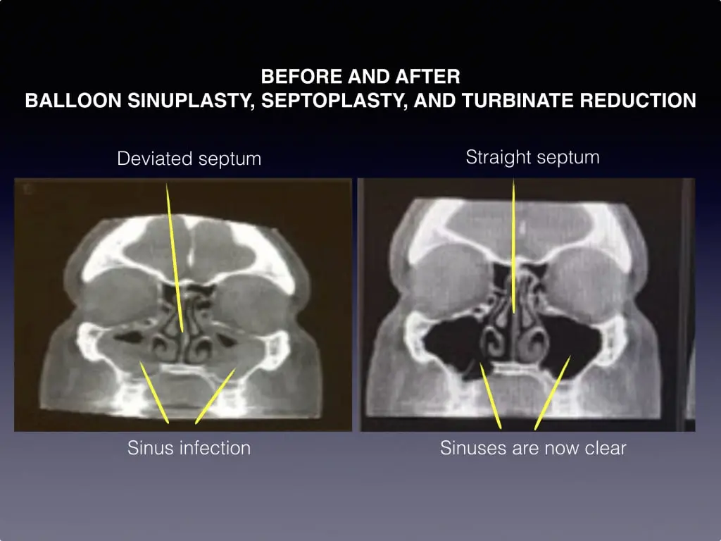 Before and after images of balloon sinuplasty, septoplasty, and Turbinate reduction
