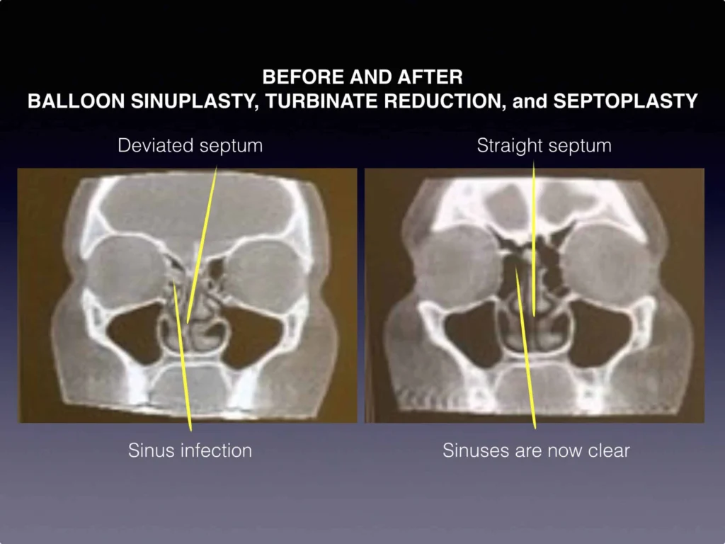 Before and after balloon sinuplasty, turbinate reduction, and septoplasty results