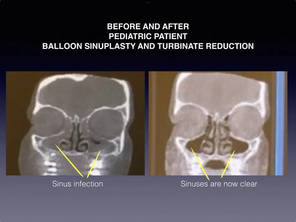 Before and After Pediatric patient, Balloon Sinuplasty, and Turbinate Reduction results