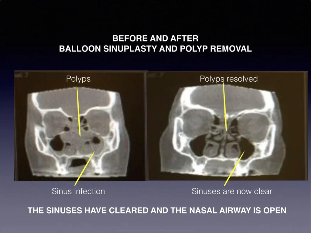 Before and after balloon sinuplasty and polyp removal procedure