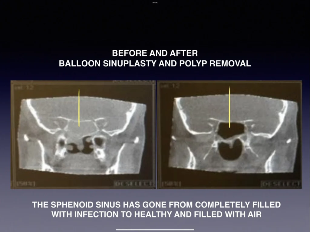 Before and after balloon sinuplasty and nasal polyp removal procedure