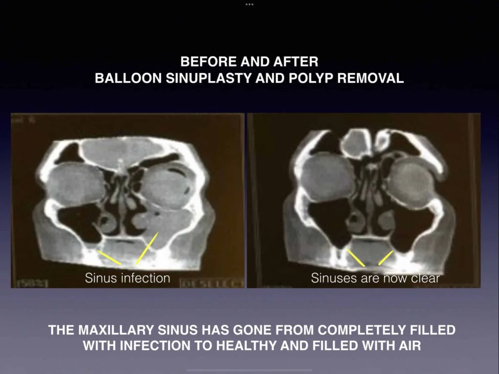 Balloon sinuplasty before and after nasal polyp removal results