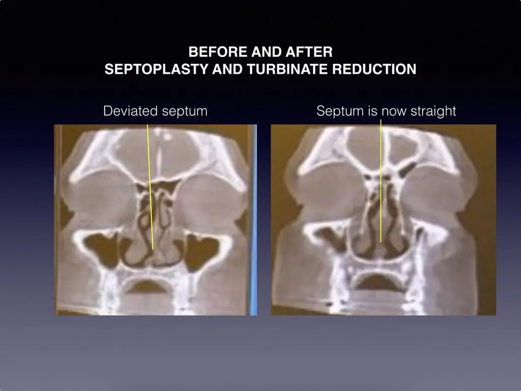 Before and after septoplasty and turbinate reduction results