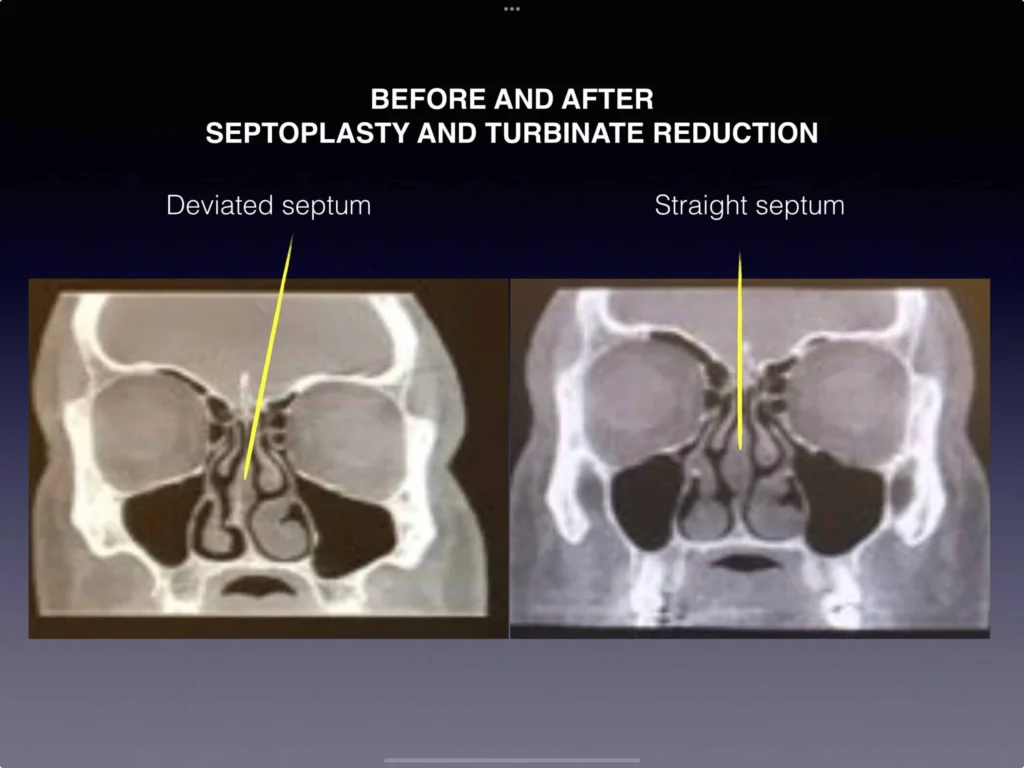 Before and after septoplasty and turbinate reduction results