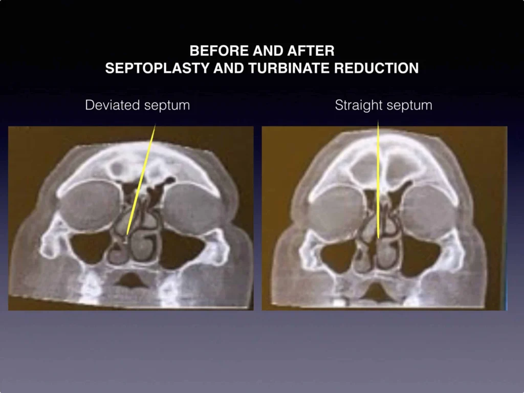 Septoplasty and turbinate reduction before and after photos