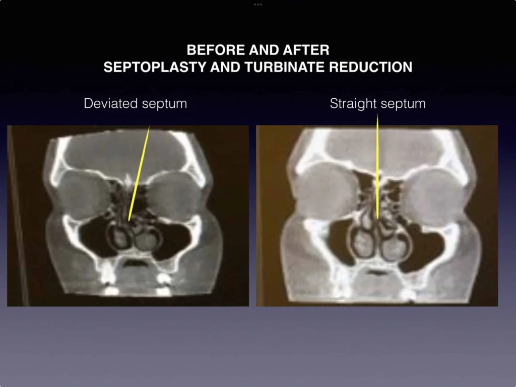 Before and after septoplasty and turbinate reduction results