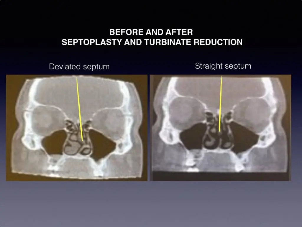 Before and after septoplasty and turbinate reduction procedure