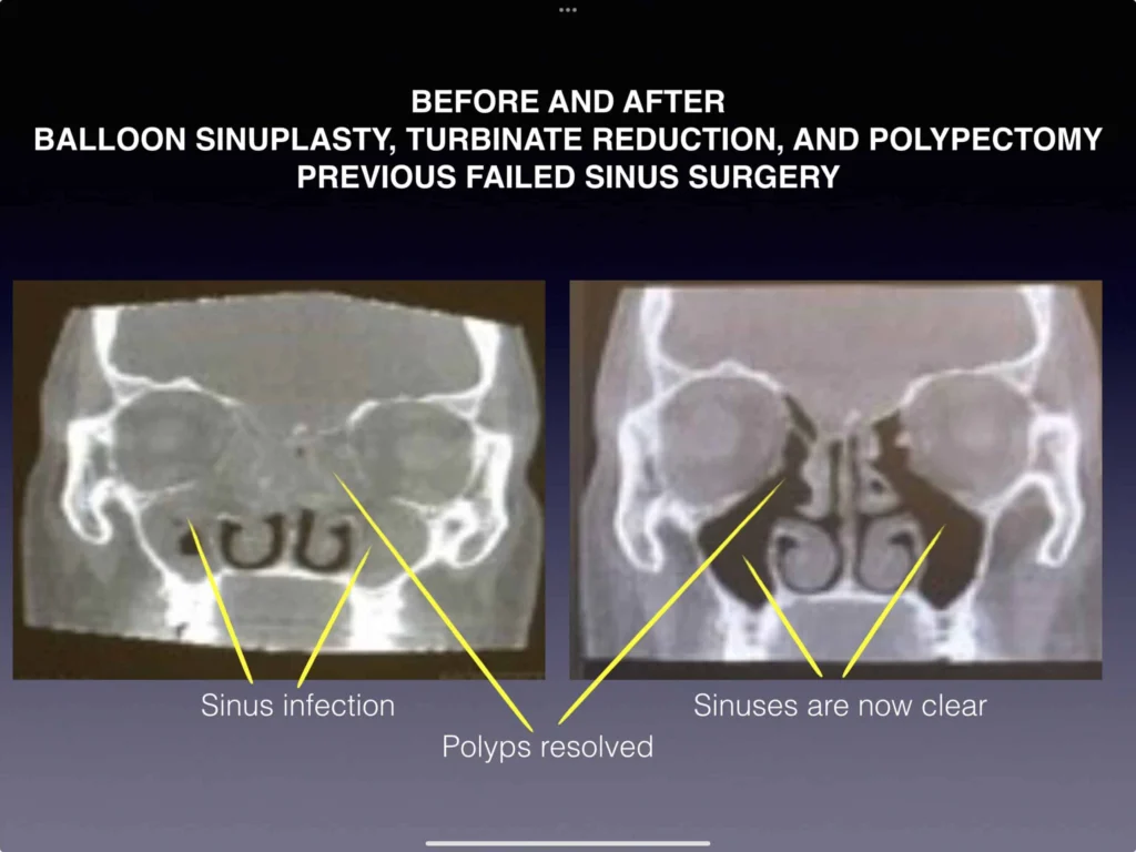 Before and After Balloon Sinuplasty, Turbinate Reduction, and Polypectomy