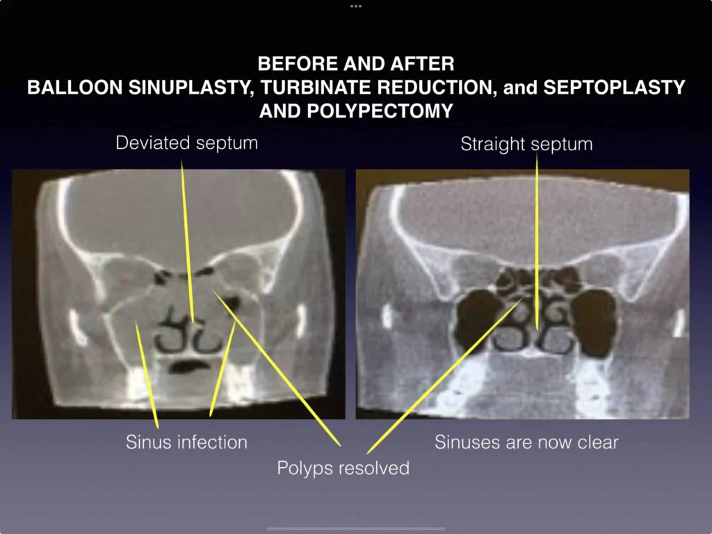 Before and after balloon sinuplasty, turbinate reduction, and septoplasty and polypectomy results
